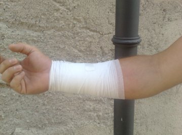 Medusa gli provoca ustione di secondo grado